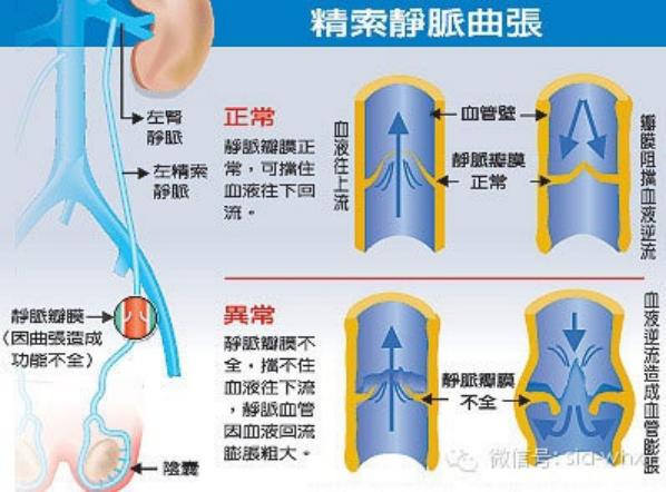 關(guān)于2021年征兵精索靜脈曲張標(biāo)準的探討，2021年征兵精索靜脈曲張標(biāo)準深度解析