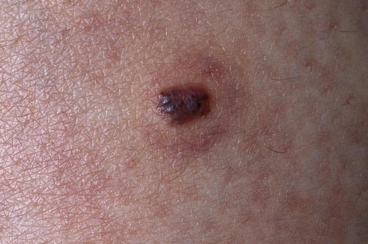 血痣和紅痣的區(qū)別圖片，深入了解兩種皮膚狀況，血痣與紅痣的區(qū)別詳解，專業(yè)圖片解析，深入了解兩種皮膚狀況特征