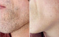 臉部脫毛需要多少錢，全面解析費用因素與選擇建議，臉部脫毛費用詳解，全面解析費用因素與選擇建議