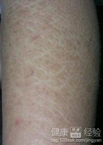 魚鱗皮膚病如何才能根治，全面解析與應對策略，全面解析魚鱗皮膚病根治之道，應對策略大揭秘