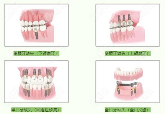 種牙多少錢一顆牙價格表2023，全面解析種植牙費用及影響因素，2023年種植牙價格表全面解析，費用、影響因素一網(wǎng)打盡