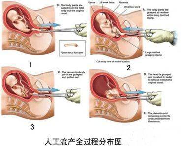 人流半個(gè)月后是否可以帶套進(jìn)行性行為？解析與注意事項(xiàng)，人流半個(gè)月后帶套性行為解析及注意事項(xiàng)