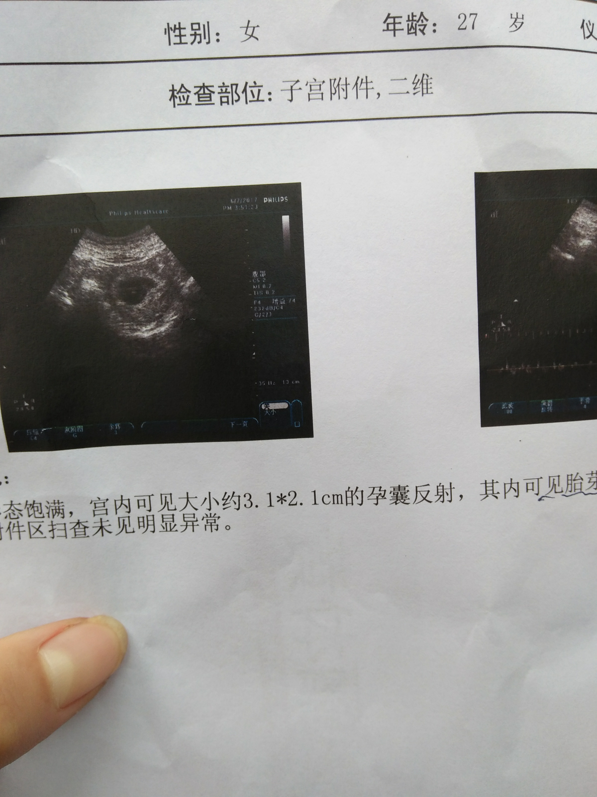 關(guān)于已生男孩孕囊圖片的探討，已生男孩的孕囊圖片深度探討