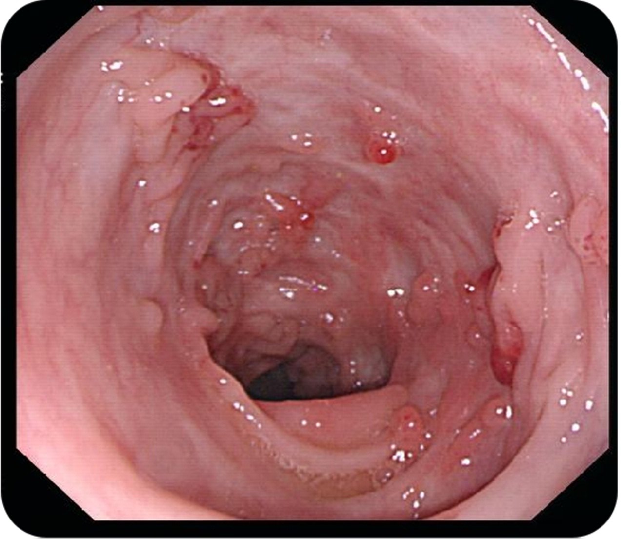 克羅恩病最常見的癥狀是什么？一篇文章深度解析，深度解析，克羅恩病最常見癥狀解析