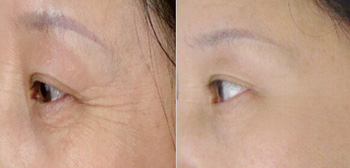 打除皺針一般價格解析，因素、市場行情及預算考量，打除皺針的價格解析，市場行情、影響因素與預算考量全知道