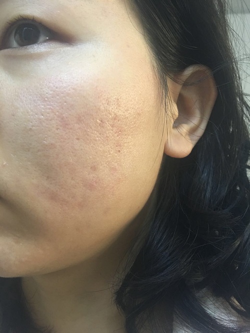 嚴(yán)重痤瘡治療最徹底的方法，全面攻略與最佳實(shí)踐，全面攻略揭秘，最徹底治療嚴(yán)重痤瘡的最佳實(shí)踐與最佳方法