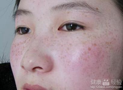 怎樣去除黃褐斑最快最有效，全面解析黃褐斑的成因與有效治療方法，全面解析黃褐斑成因及快速有效的去除方法