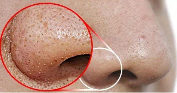 孩子身上起螨蟲疙瘩圖片，了解、預(yù)防與治療，孩子身上的螨蟲疙瘩，圖片、預(yù)防與治療全攻略