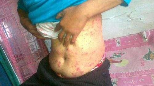 男生下面流膿，原因、應對措施與健康提醒，男性私處流膿，原因、應對與健康警示