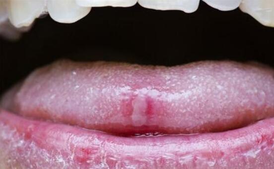 口腔粘膜炎癥，深入了解與治療策略，口腔粘膜炎癥，全面解析與治療指南
