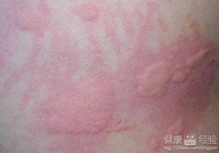 風疹是怎么引起的，風疹的成因解析