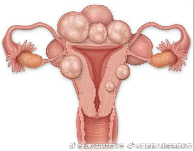 子宮肌瘤的最佳治療方法，全面解析與指導(dǎo)，子宮肌瘤的最佳治療方法詳解與指導(dǎo)手冊(cè)